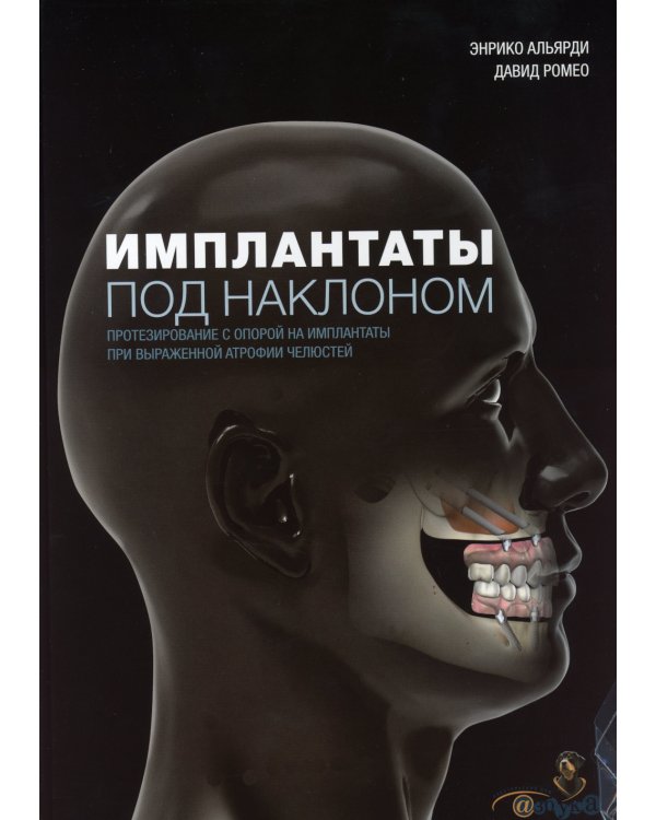 Имплантаты под наклоном. Протезирование с опорой на имплантаты при выраженной атрофии челюстей