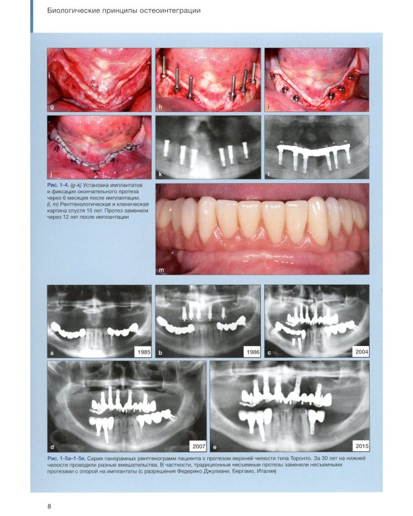 Имплантаты под наклоном. Протезирование с опорой на имплантаты при выраженной атрофии челюстей
