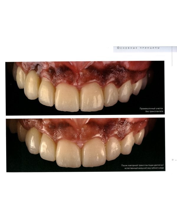 Керамические виниры