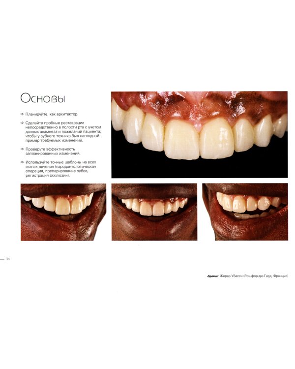 Керамические виниры