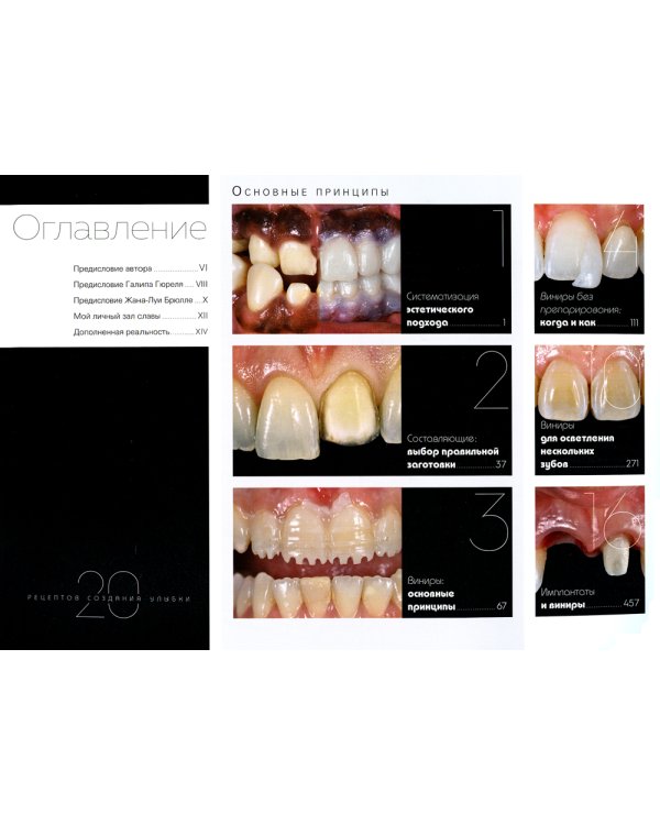 Керамические виниры