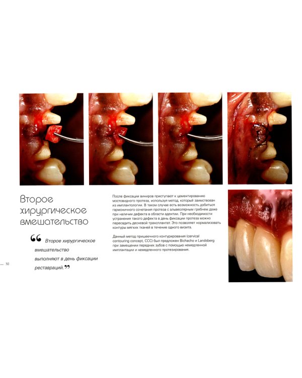 Керамические виниры