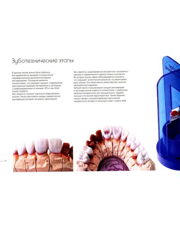 Керамические виниры