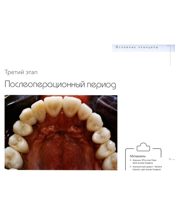 Керамические виниры