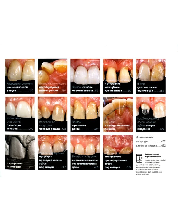 Керамические виниры