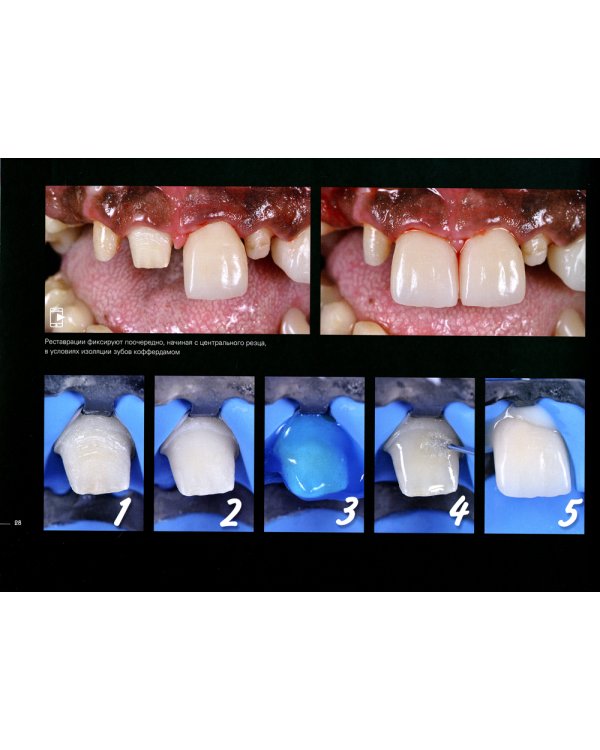 Керамические виниры
