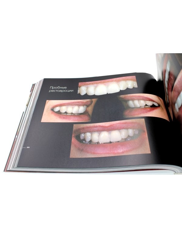 Керамические виниры