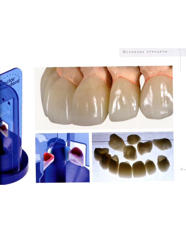 Керамические виниры