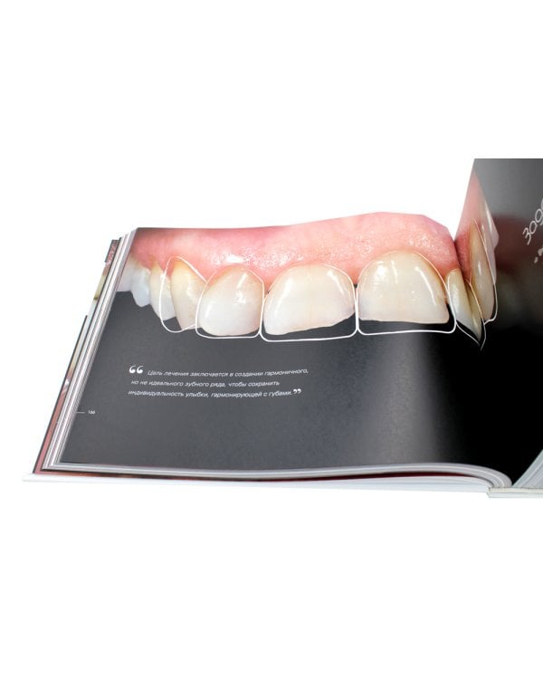 Керамические виниры