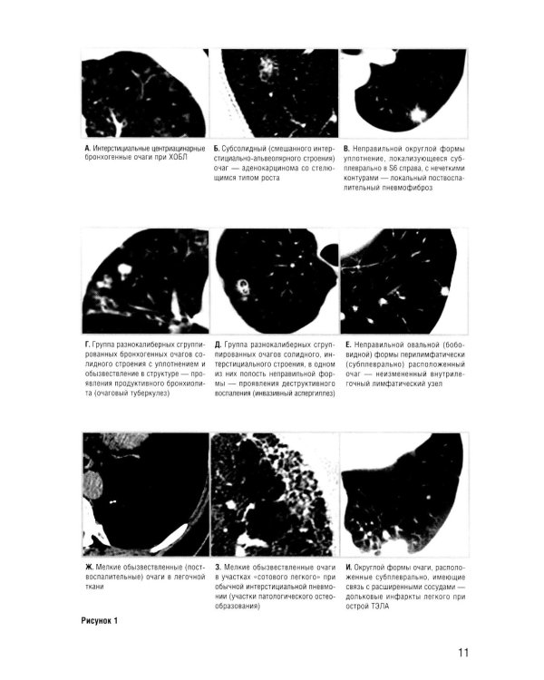 Заключение в торакальной компьютерной томографии. Симптом, синдром, диагноз. 3-е изд