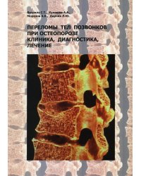 Переломы тел позвонков при остеопорозе. Клиника, диагностика, лечение