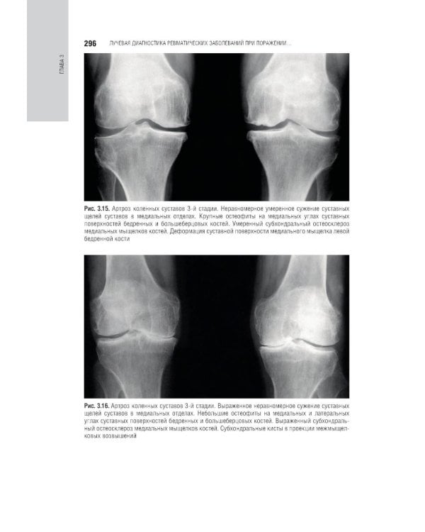 Лучевая диагностика заболеваний костей и суставов: национальное руководство. 2-е изд., перераб. и доп