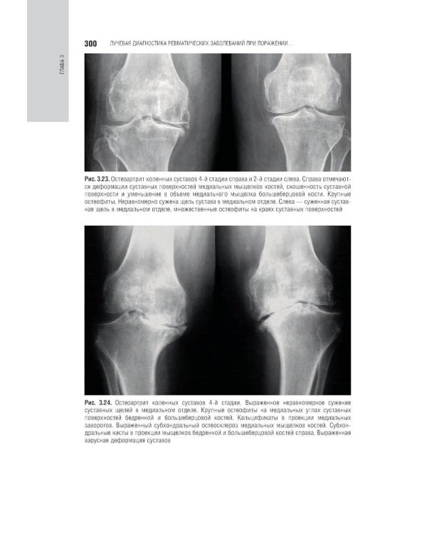 Лучевая диагностика заболеваний костей и суставов: национальное руководство. 2-е изд., перераб. и доп