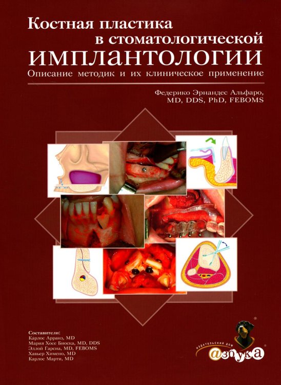 Костная пластика в стоматологической имплантологии. Описание методик и их клиническое применение Костная пластика в стоматологической имплантологии. Описание методик и их клиническое применение