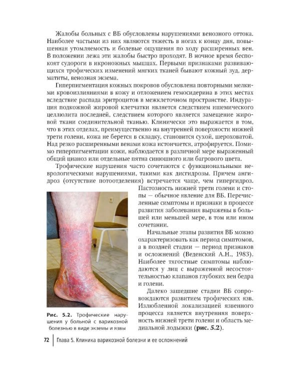 Рецидив варикозной болезни