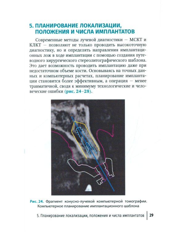 Рентгенологическая оценка качества имплантационного протезирования: руководство для врачей