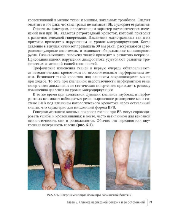 Рецидив варикозной болезни