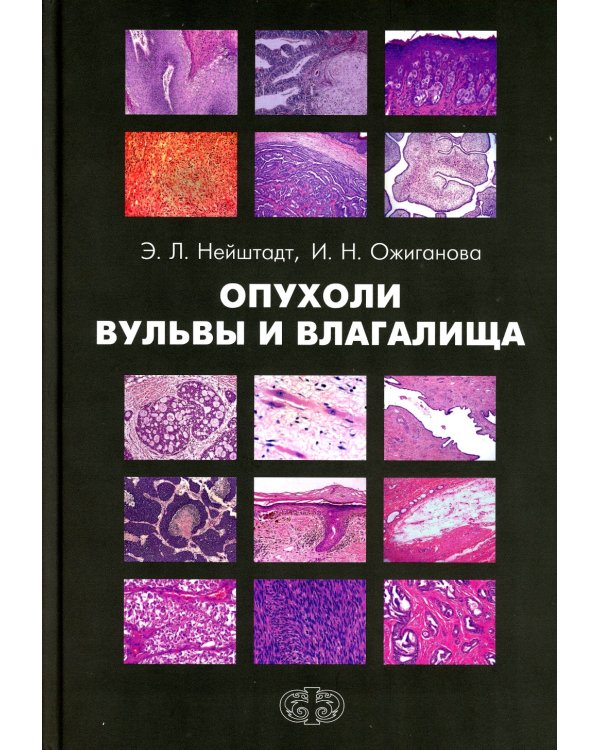 Опухоли вульвы и влагалища