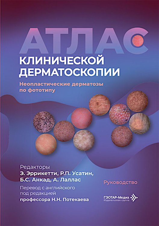 Обложка книги «Атлас клинической дерматоскопии. Ненеопластические дерматозы по фототипу: руководство» — None, ISBN 9785970498583