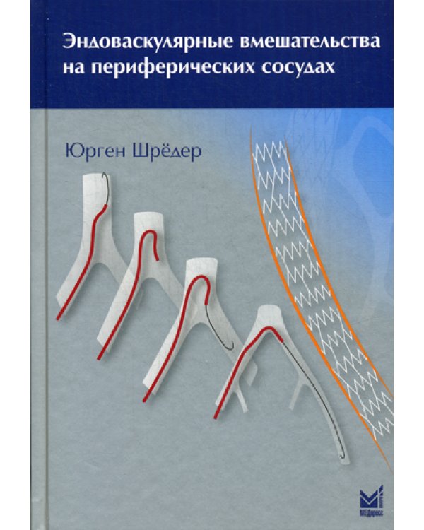 Эндоваскулярные вмешательства на периферических сосудах