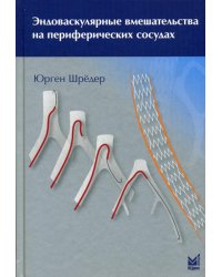 Эндоваскулярные вмешательства на периферических сосудах