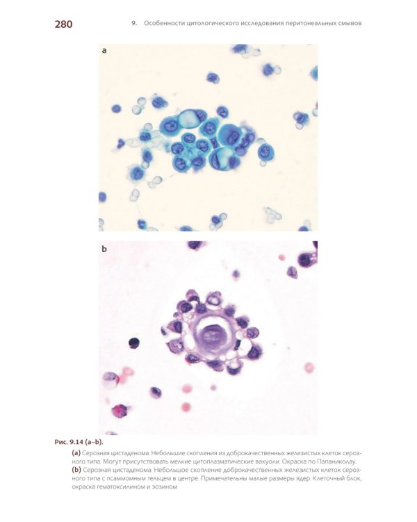 Международная классификация цитопатологии выпотных жидкостей
