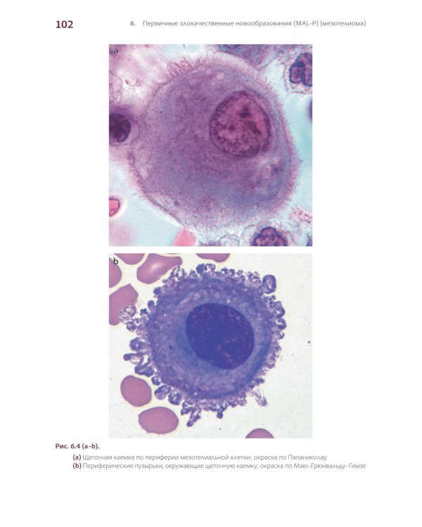 Международная классификация цитопатологии выпотных жидкостей