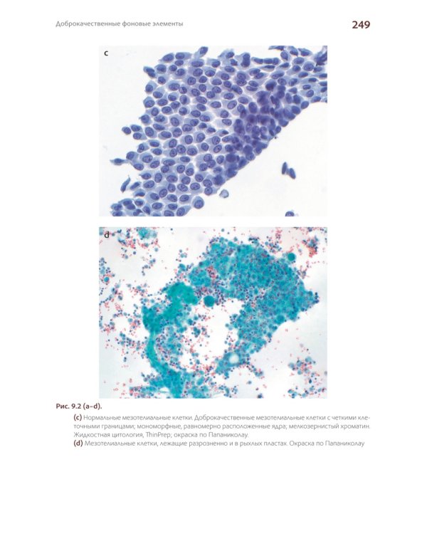Международная классификация цитопатологии выпотных жидкостей