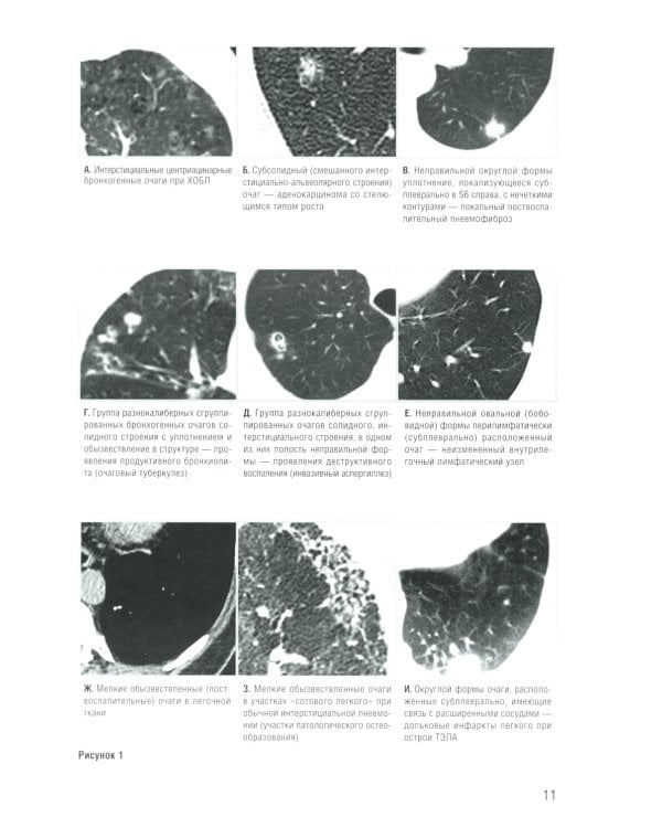 Заключение в торакальной компьютерной томографии. Симптом, синдром, диагноз. 2-е изд