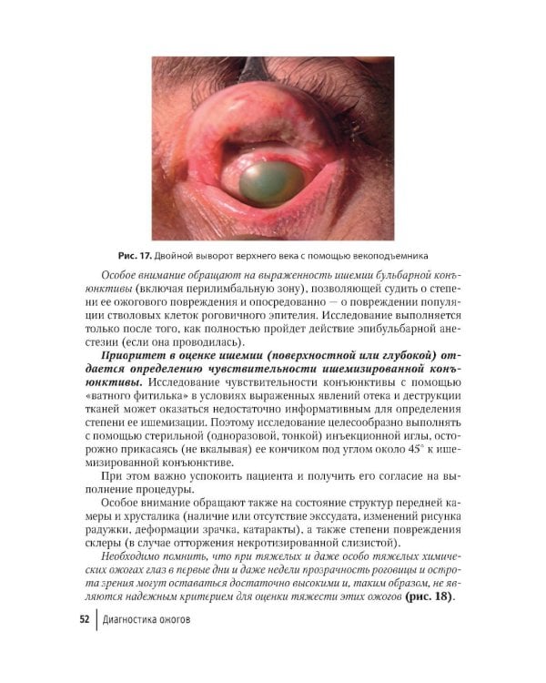 Ожоги глаз. Состояние проблемы и новые подходы. 3-е изд., перераб. и доп