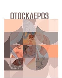 Отосклероз