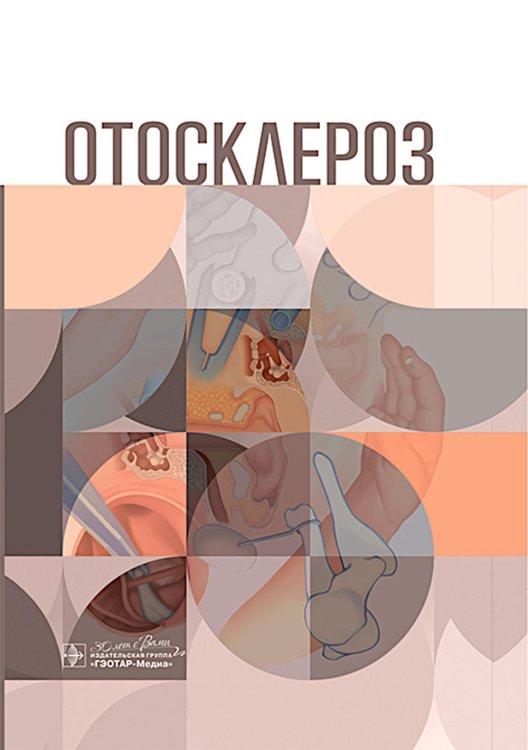 Отосклероз Отосклероз
