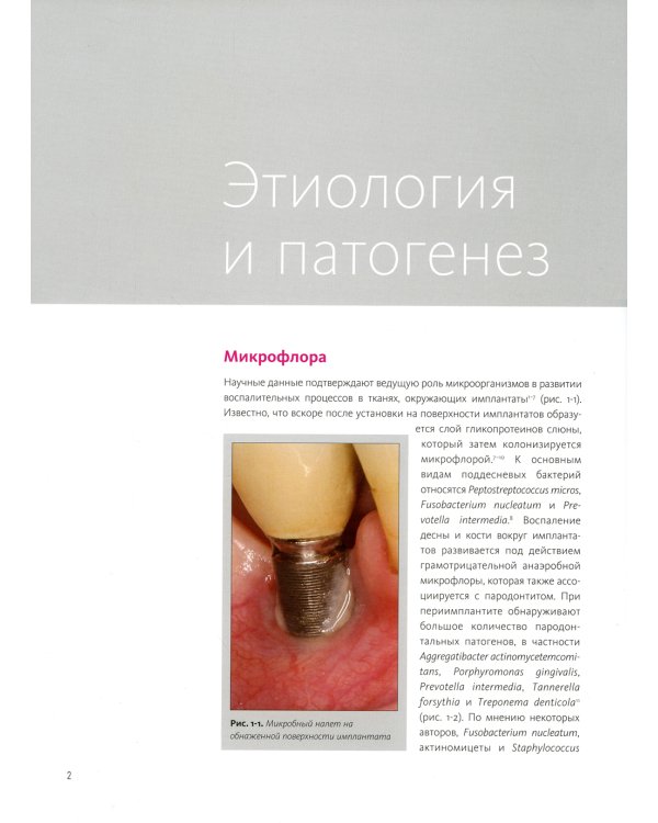 Периимплантит