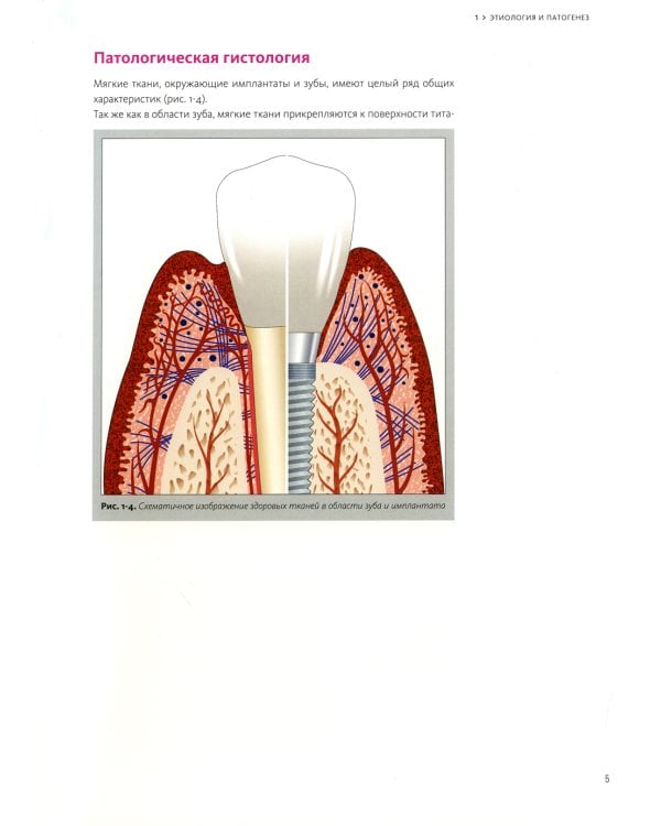 Периимплантит