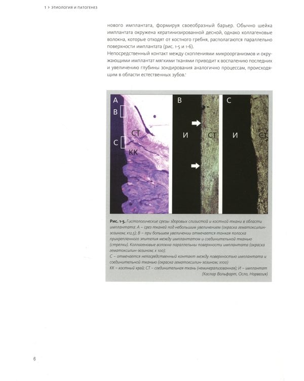 Периимплантит