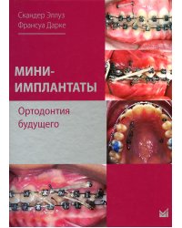 Мини-имплантаты. Ортодонтия будущего