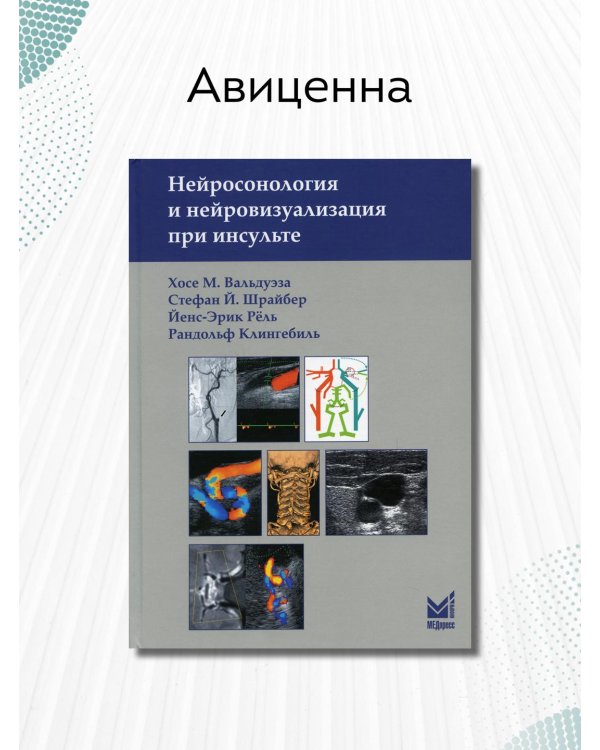 Нейросонология и нейровизуализация при инсульте