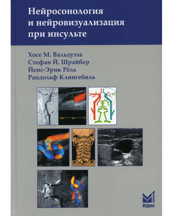 Нейросонология и нейровизуализация при инсульте