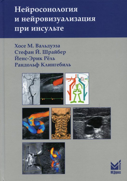 Нейросонология и нейровизуализация при инсульте