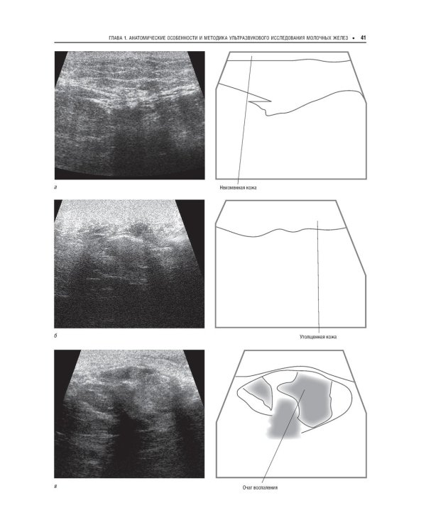 Практическая ультразвуковая диагностика: Руководство для врачей. В 5 т. Т. 5. Ультразвуковая диагностика заболеваний молочных желез и мягких тканей