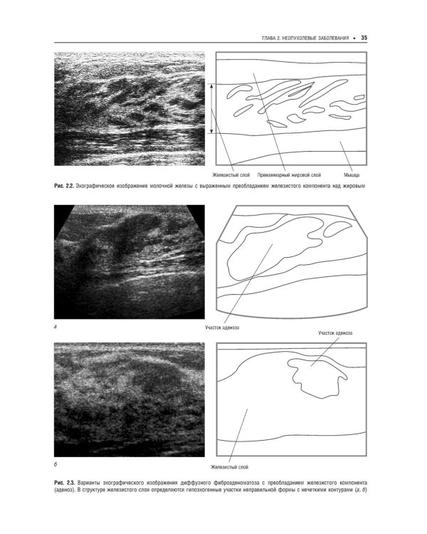 Практическая ультразвуковая диагностика: Руководство для врачей. В 5 т. Т. 5. Ультразвуковая диагностика заболеваний молочных желез и мягких тканей