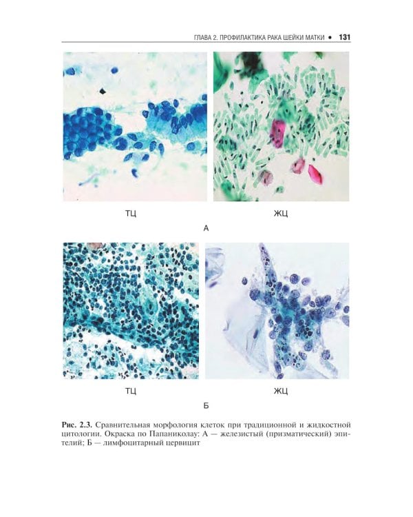 Цитологическое исследование цервикальных мазков — Пап-тест