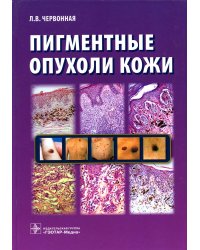 Пигментные опухоли кожи