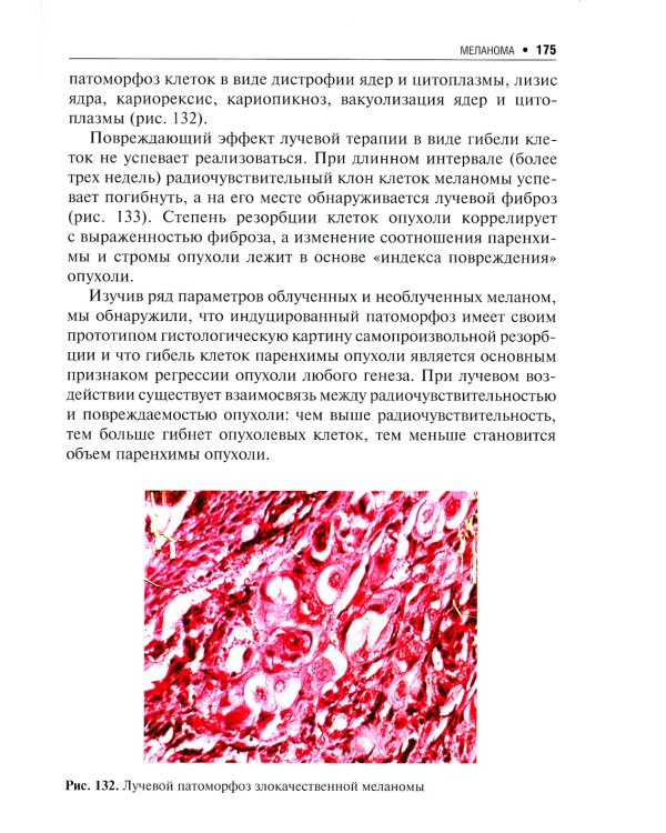 Пигментные опухоли кожи