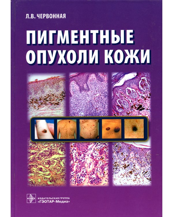 Пигментные опухоли кожи