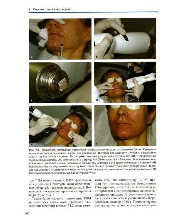 PRP и микронидлинг в эстетической медицине