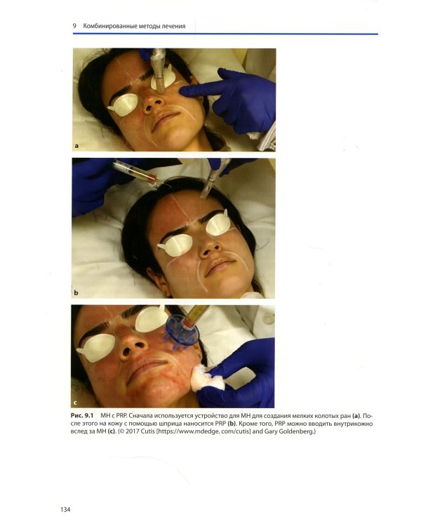 PRP и микронидлинг в эстетической медицине