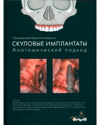 Скуловые имплантаты. Анатомический подход