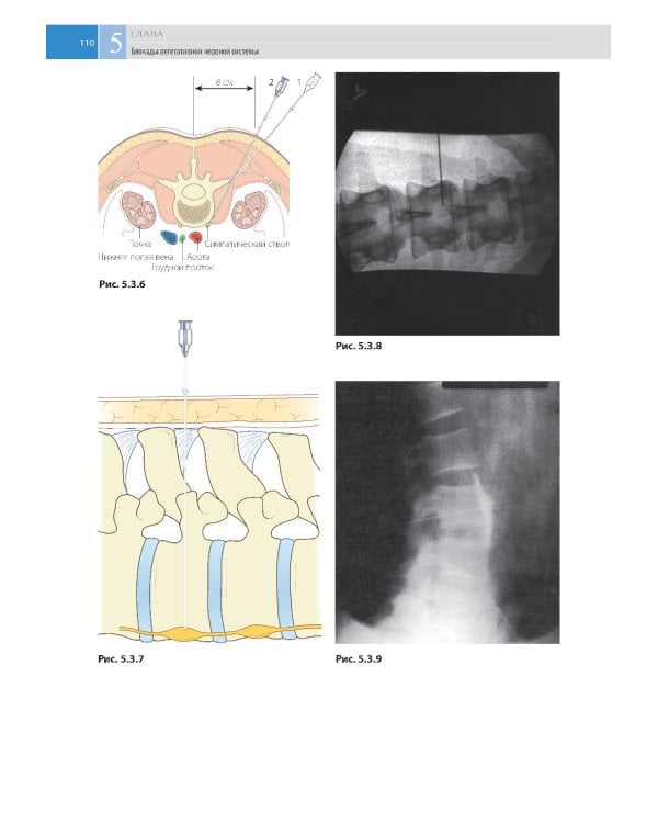 Атлас по инъекционным методам лечения боли. 2-е изд