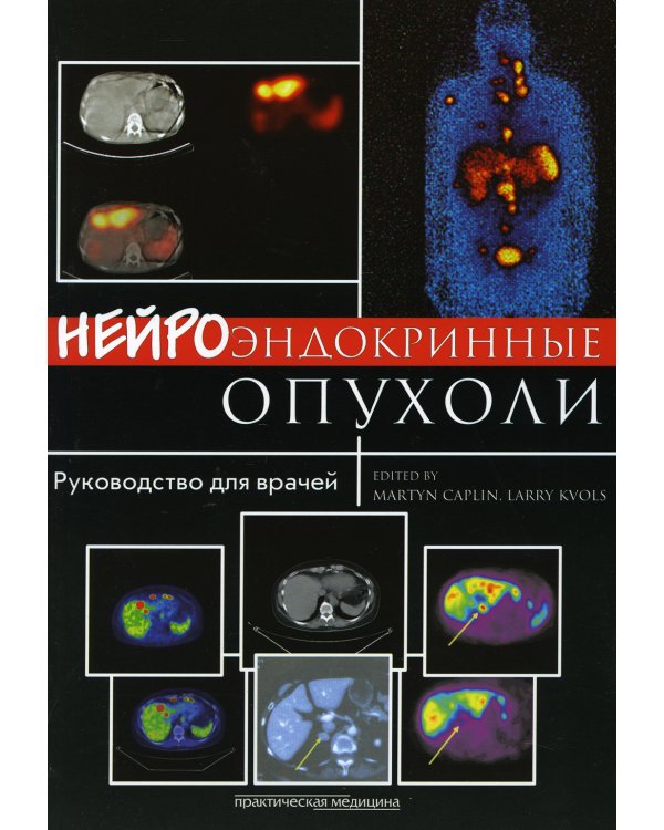 Нейроэндокринные опухоли Руководство для врачей